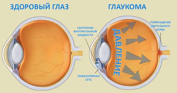 сравнение здорового глаза и больного глаукомой