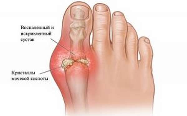 Болит сустав большого пальца ноги