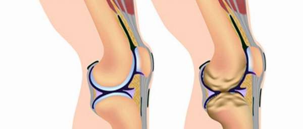 Гонартроз первой степени