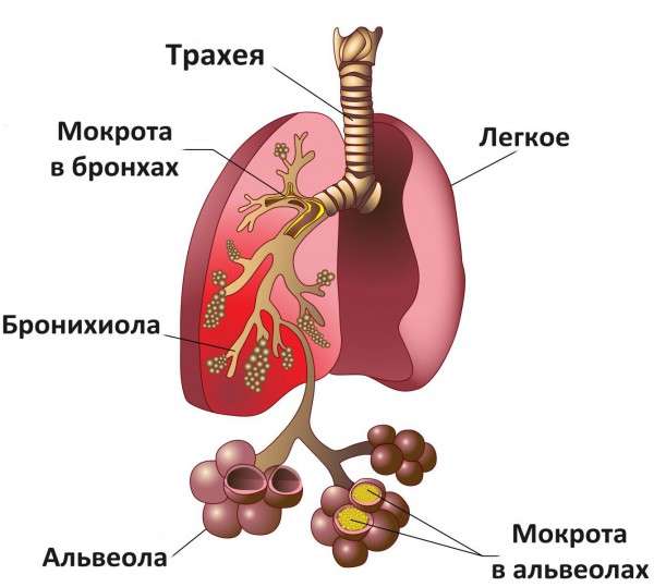 как бронхит отличить от пневмонии