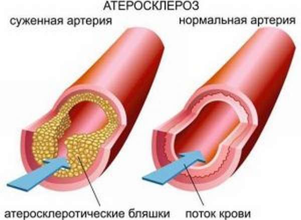 Лечение суставов солью