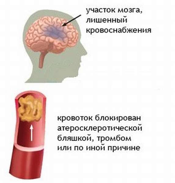 Атеросклеротический склероз. Атеросклеротическая бляшка в сонной артерии. Холестериновая бляшка в сонной артерии. Презентация атеросклероз сонных артерий.