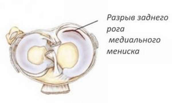 Мр картина повреждения внутреннего мениска 3а степени по stoller