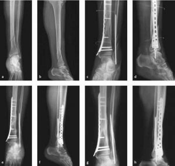 Перелом кости рентген. Перелом большеберцовой кости и малоберцовой кости. Перелом большеберцовой кости рентген. Перелом нижней трети большеберцовой кости рентген. Винтообразный перелом большеберцовой кости рентген.