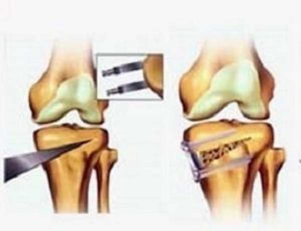 После остеотомии коленного сустава