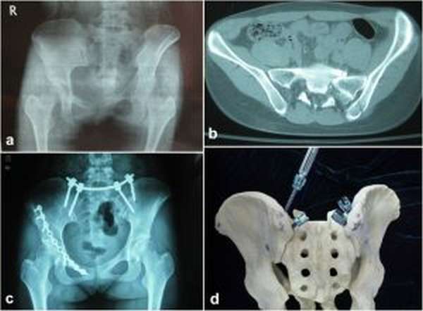 Таз лечение. Перелом седалищной кости гипс. Перелом лонной и седалищной костей. Перелом седалищной кости таза.