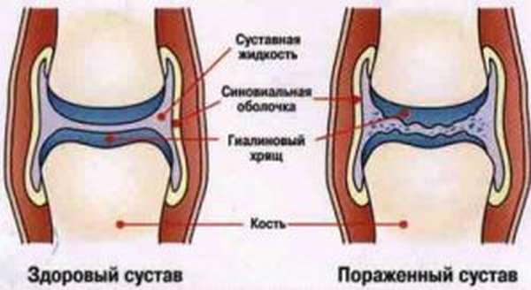 Суставной хрящ. Суставной гиалиновый хрящ толщина норма. Строение сустава гиалиновый хрящ. Гиалиновый хрящ коленного сустава норма. Норма суставного хряща коленного сустава.