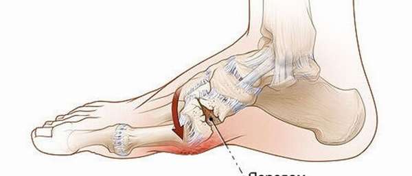 Перелом ступни