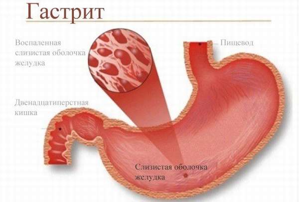 гастрит