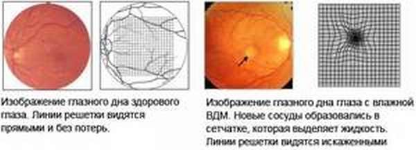 Тест сетчатки глаза. Макулярная дегенерация сетчатки глаза. Отслоение сетчатки глазное дно. Макулярная дистрофия глаза. Возрастная макулодистрофия глазное дно.