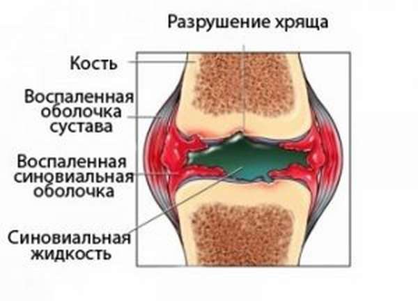 Жидкость в суставах. Воспаление синовиальной оболочки. Синовиальная оболочка воспаленная. Воспаленная синовиальная оболочка сустава. Изменение суставной жидкости.