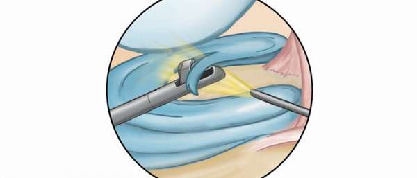 Резекция коленного мениска