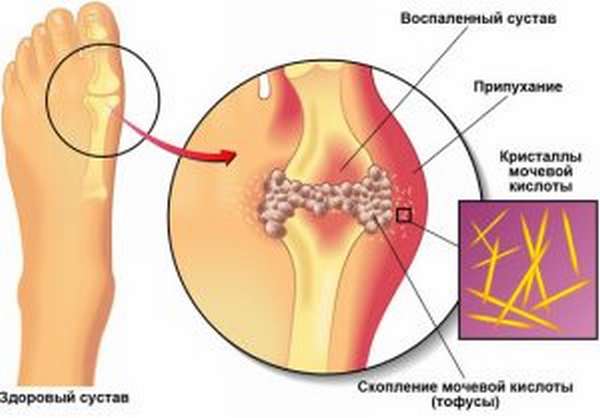 Подагра и мочевая кислота