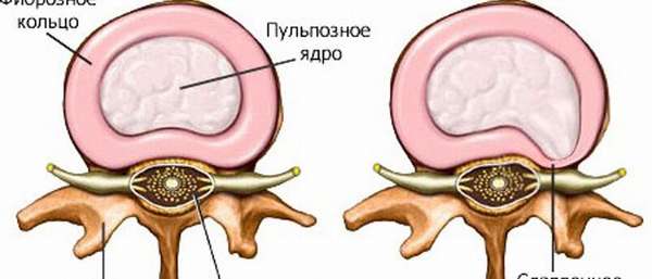 Протрузия дисков поясничного отдела позвоночника