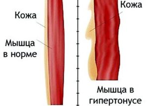 Баня при позвоночной грыже