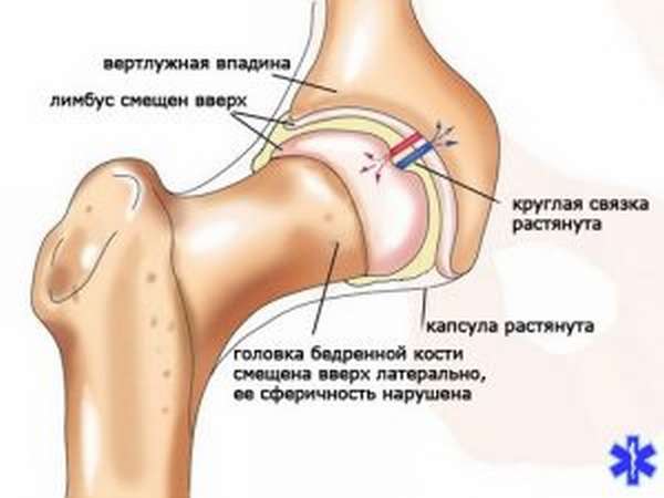 Схема дисплазии тазобедренных суставов у новорожденных