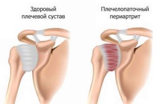 Могут ли увеличиваться лимфоузлы при остеохондрозе?