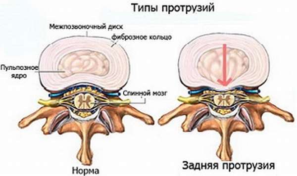 Протрузия диска шейного отдела позвоночника лечение
