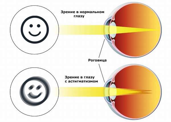 схема астигматизма