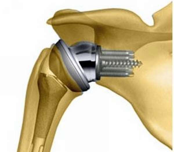 Сустав спб. Тотальное эндопротезирование плечевого сустава. Реверсивный эндопротез плечевого сустава. Однополюсное эндопротезирование плечевого сустава. Эндопротез плечевого сустава Тотальный реверсивный.