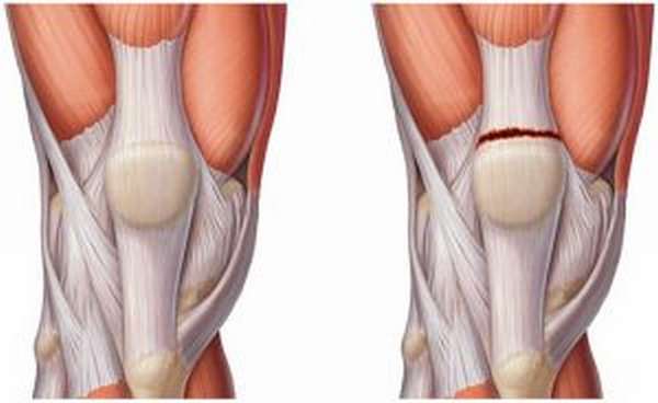 Боль в колене при нагрузке