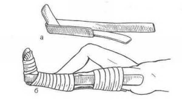 Шина при переломе костей. Транспортная иммобилизация при переломе голени Крамера. Перелом голени шина Крамера. Наложение шины Крамера при переломе костей голени. Шина Крамера перелом костей голени.