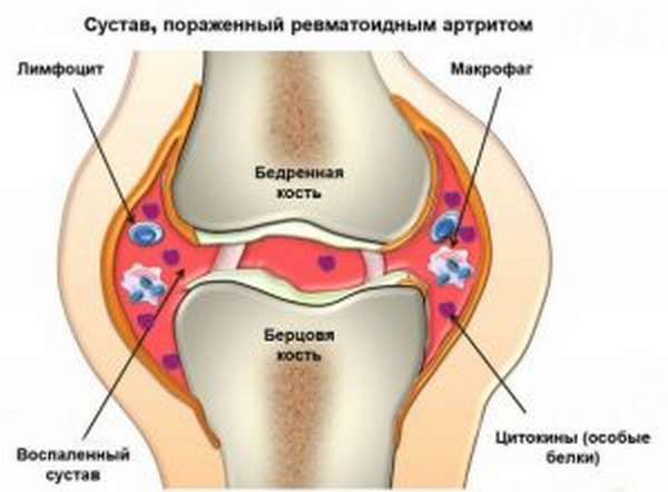 Боль в колене при нагрузке