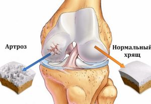 Препараты для лечения артроза коленных суставов