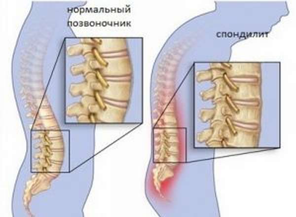 Вобэнзим для лечения суставов