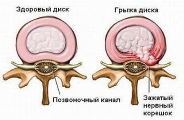 Снижение высоты межпозвонковых дисков